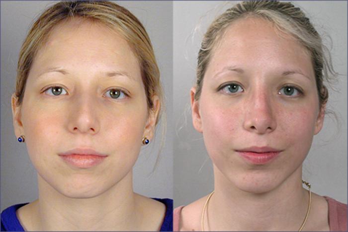 Rhinoplasty Case 118 Before & After View #1 | Paramus, New Jersey | Parker Center for Plastic Surgery
