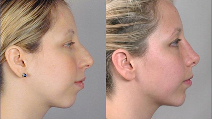 Rhinoplasty Case 118 Before & After View #2 | Paramus, New Jersey | Parker Center for Plastic Surgery