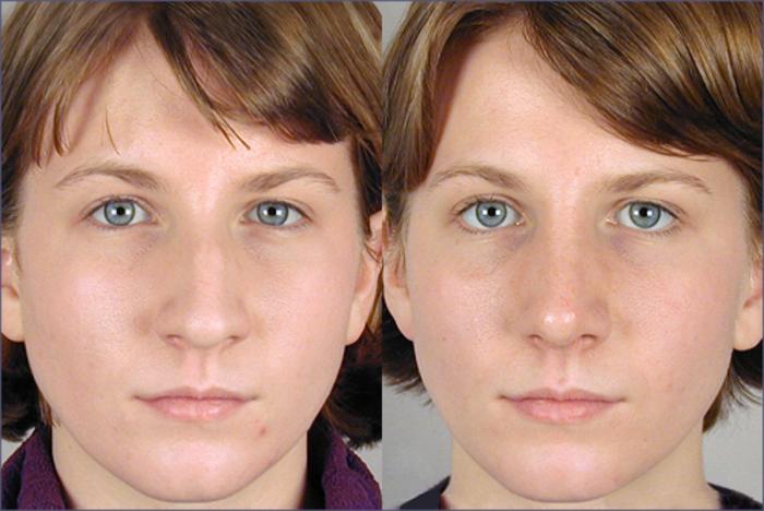 Rhinoplasty Case 119 Before & After View #1 | Paramus, New Jersey | Parker Center for Plastic Surgery