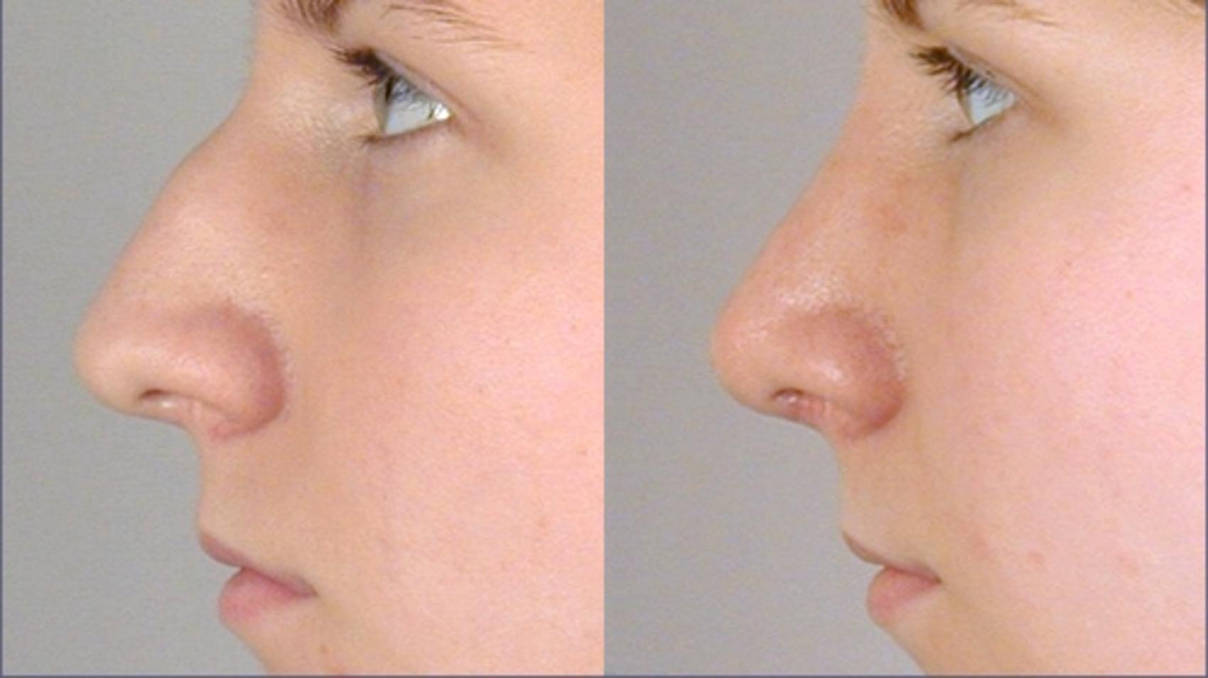 Rhinoplasty Case 119 Before & After View #2 | Paramus, New Jersey | Parker Center for Plastic Surgery