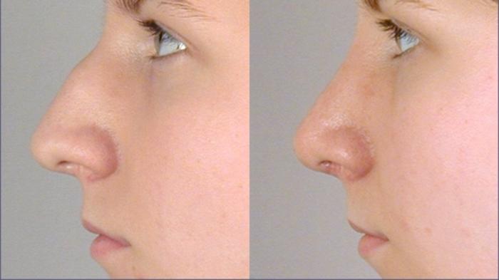 Rhinoplasty Case 119 Before & After View #2 | Paramus, New Jersey | Parker Center for Plastic Surgery