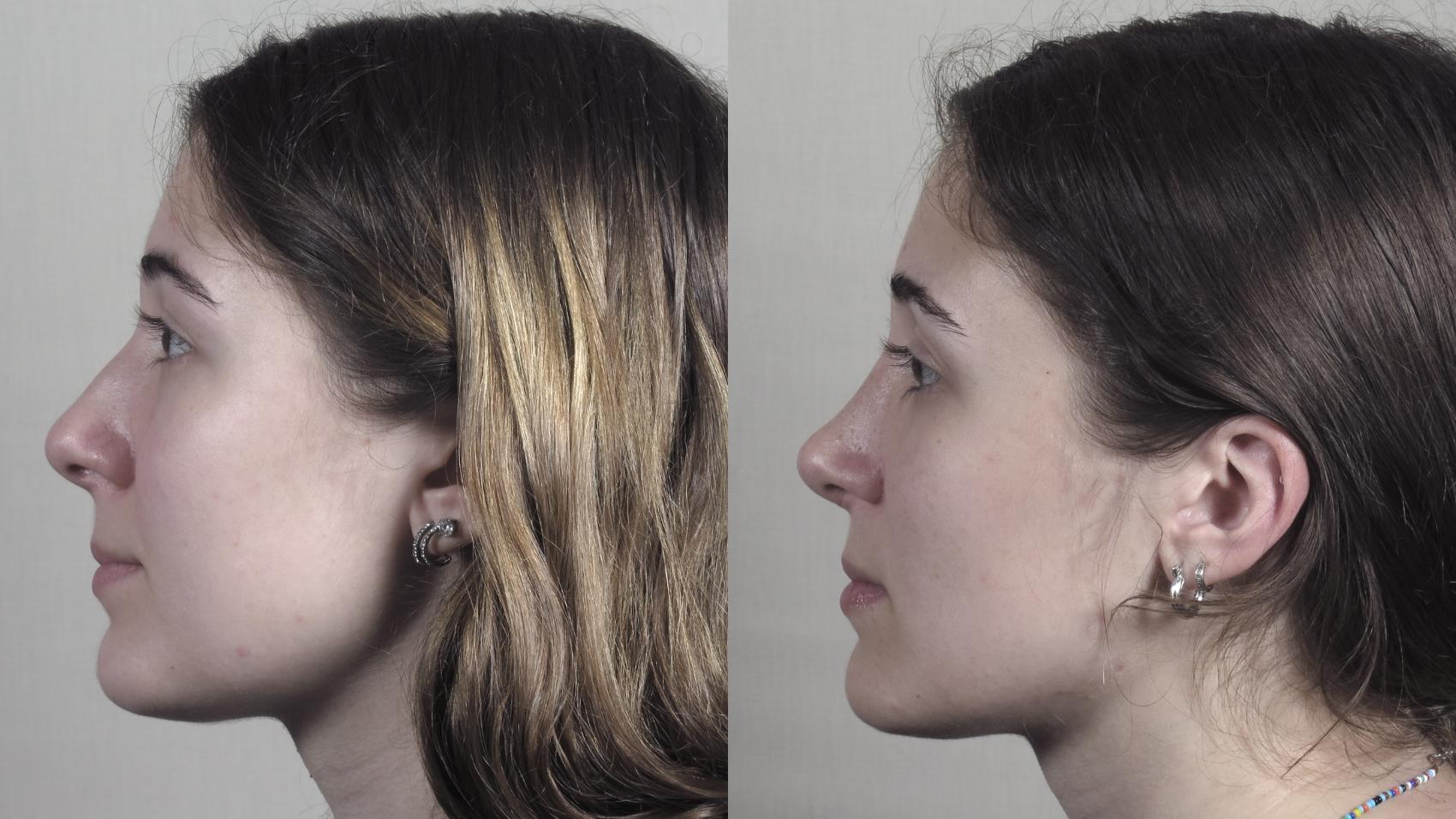 Rhinoplasty Case 1192 Before & After View #1  | Paramus, New Jersey | Parker Center for Plastic Surgery