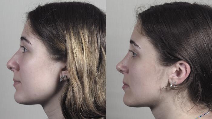 Rhinoplasty Case 1192 Before & After View #1  | Paramus, New Jersey | Parker Center for Plastic Surgery