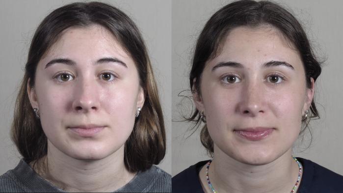 Rhinoplasty Case 1192 Before & After View #2 | Paramus, New Jersey | Parker Center for Plastic Surgery