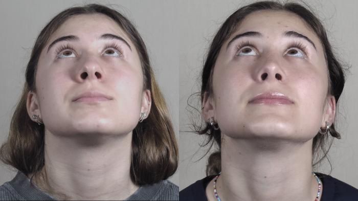 Rhinoplasty Case 1192 Before & After View #3 | Paramus, New Jersey | Parker Center for Plastic Surgery