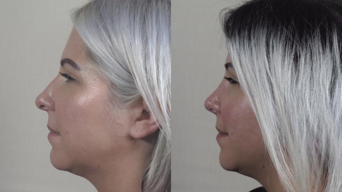 Rhinoplasty Case 1193 Before & After View #1  | Paramus, New Jersey | Parker Center for Plastic Surgery