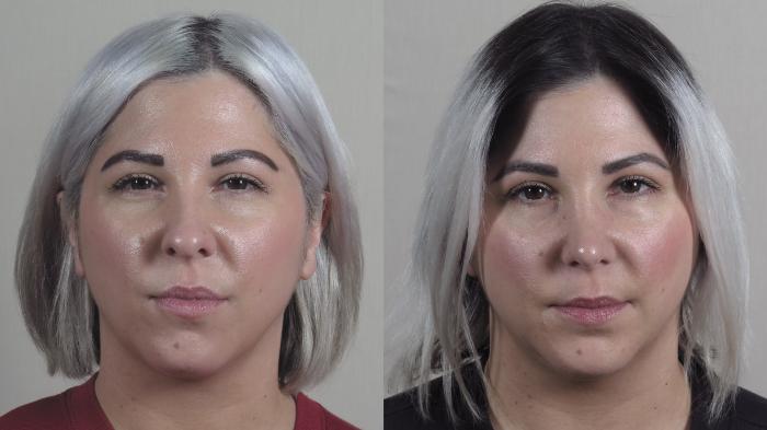Rhinoplasty Case 1193 Before & After View #2 | Paramus, New Jersey | Parker Center for Plastic Surgery