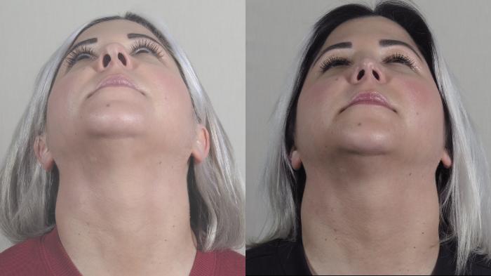 Rhinoplasty Case 1193 Before & After View #3 | Paramus, New Jersey | Parker Center for Plastic Surgery