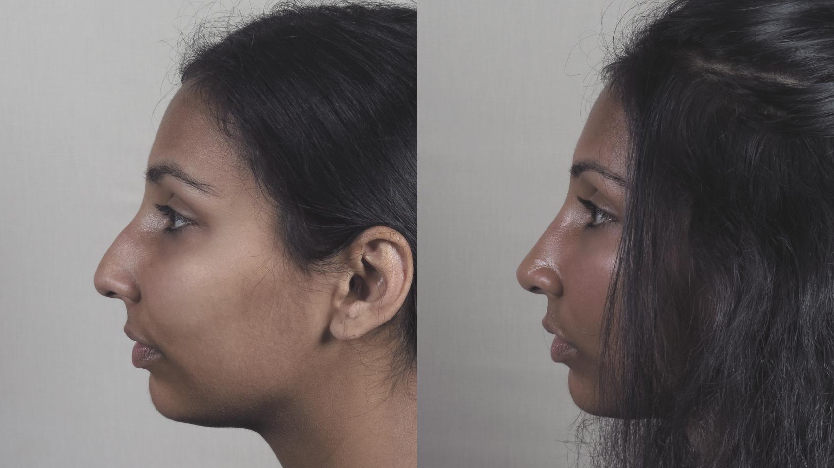 Rhinoplasty Case 1194 Before & After View #1  | Paramus, New Jersey | Parker Center for Plastic Surgery