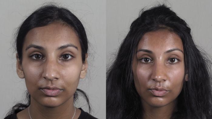 Rhinoplasty Case 1194 Before & After View #2 | Paramus, New Jersey | Parker Center for Plastic Surgery