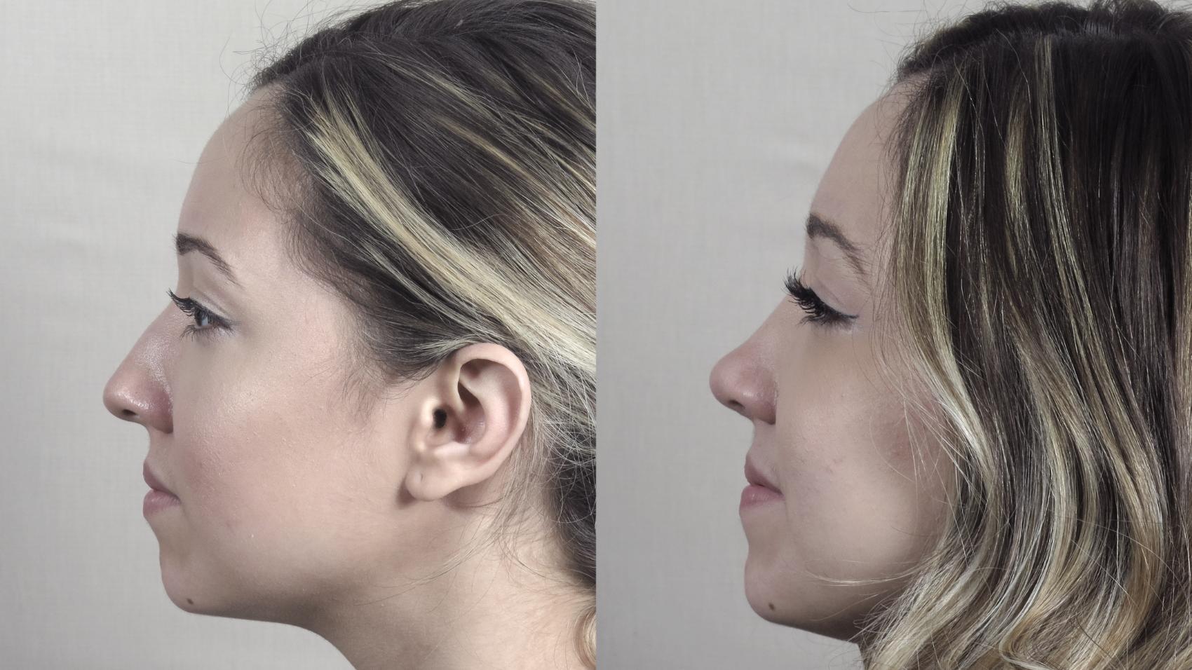 Rhinoplasty Case 1201 Before & After View #1  | Paramus, New Jersey | Parker Center for Plastic Surgery