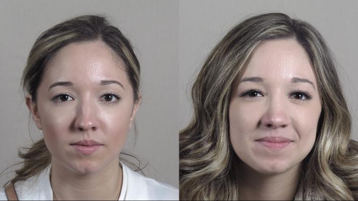 Rhinoplasty Case 1201 Before & After View #2  | Paramus, New Jersey | Parker Center for Plastic Surgery