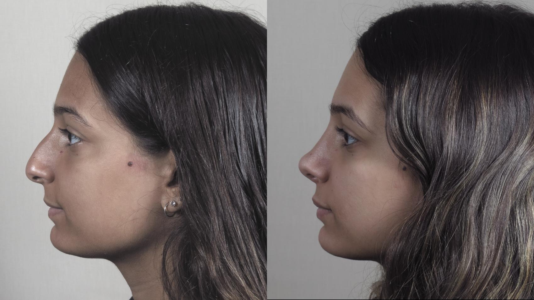 Rhinoplasty Case 1202 Before & After View #1  | Paramus, New Jersey | Parker Center for Plastic Surgery
