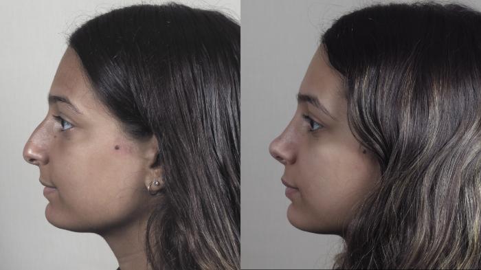 Rhinoplasty Case 1202 Before & After View #1  | Paramus, New Jersey | Parker Center for Plastic Surgery