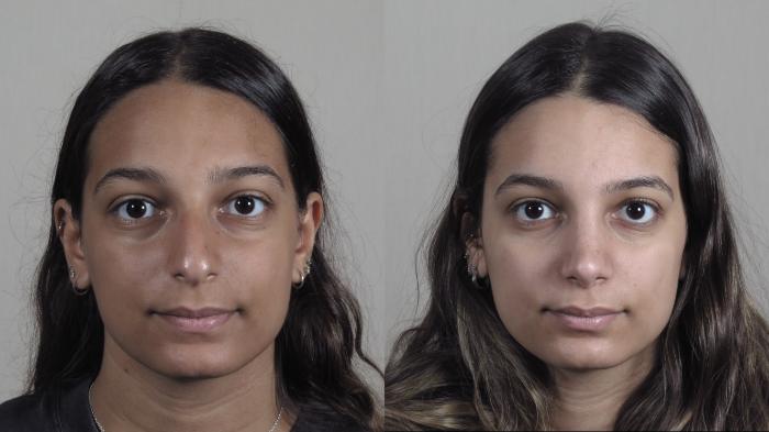 Rhinoplasty Case 1202 Before & After View #2 | Paramus, New Jersey | Parker Center for Plastic Surgery