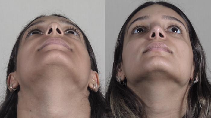 Rhinoplasty Case 1202 Before & After View #3 | Paramus, New Jersey | Parker Center for Plastic Surgery