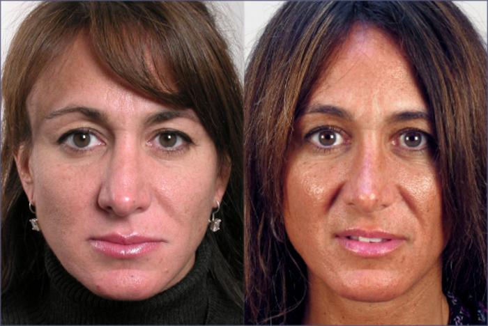 Rhinoplasty Case 121 Before & After View #1 | Paramus, New Jersey | Parker Center for Plastic Surgery