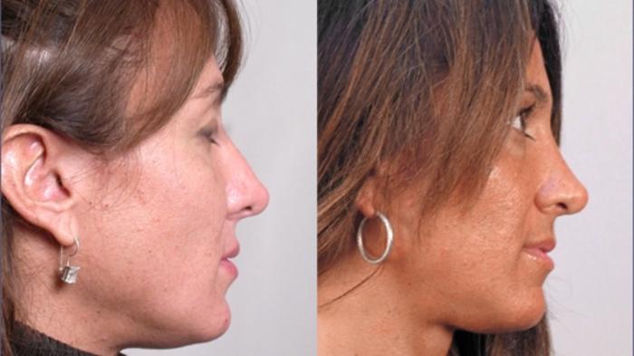 Rhinoplasty Case 121 Before & After View #2 | Paramus, New Jersey | Parker Center for Plastic Surgery