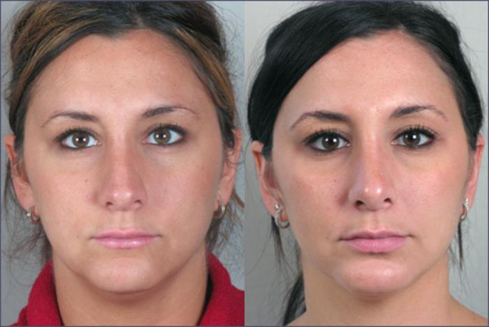 Rhinoplasty Case 122 Before & After View #1 | Paramus, New Jersey | Parker Center for Plastic Surgery
