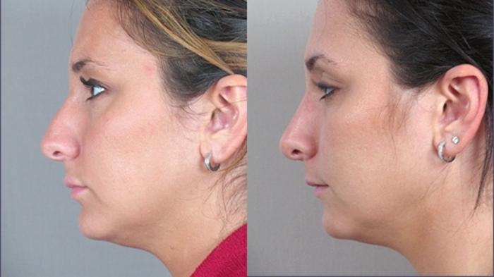 Rhinoplasty Case 122 Before & After View #2 | Paramus, New Jersey | Parker Center for Plastic Surgery