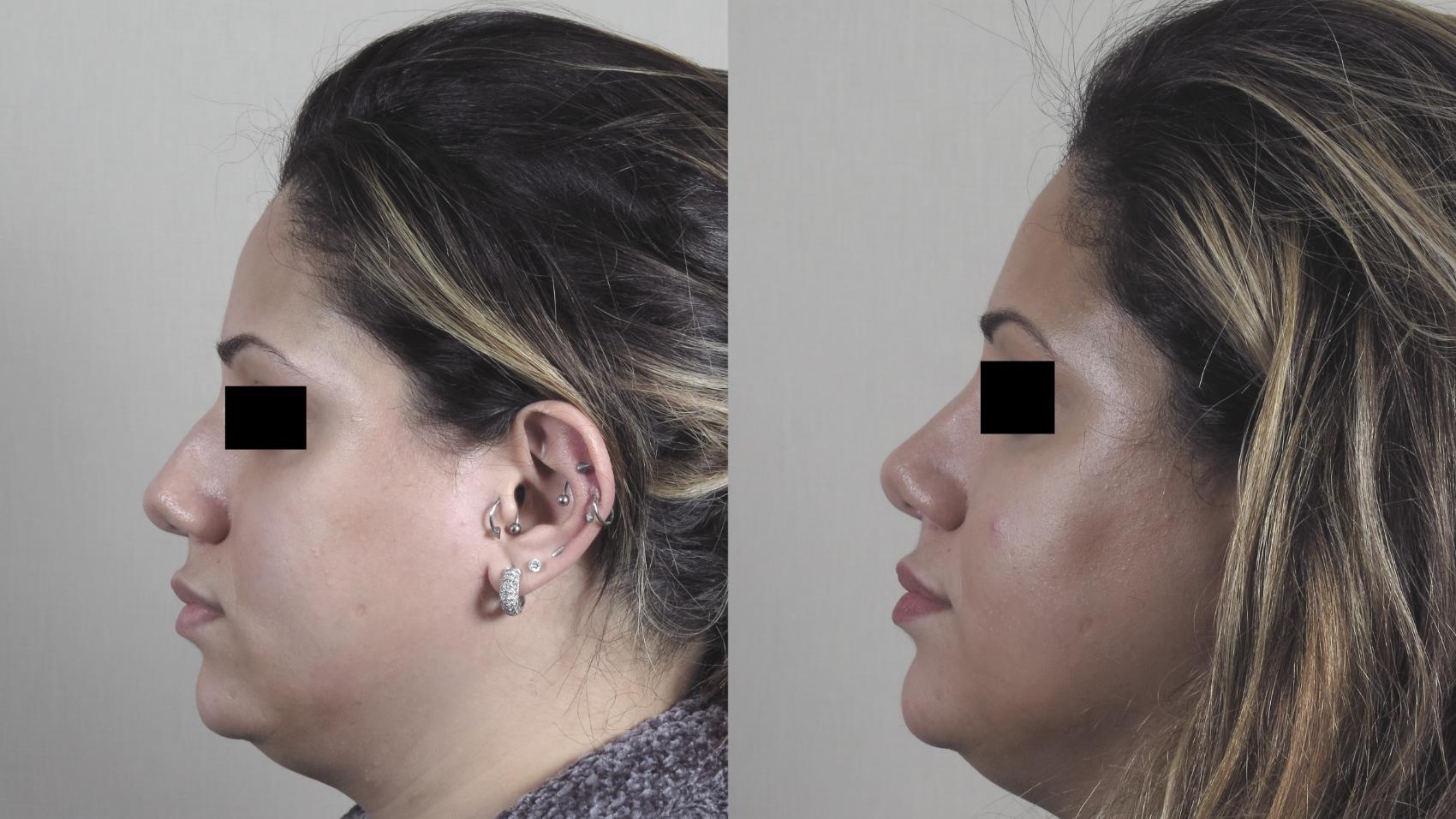 Rhinoplasty Case 1223 Before & After View #1  | Paramus, New Jersey | Parker Center for Plastic Surgery