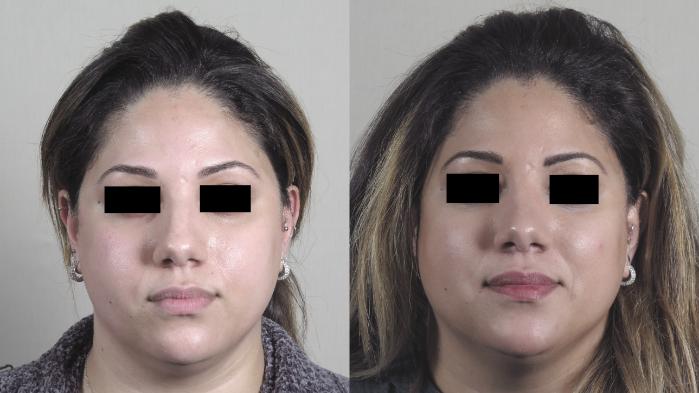 Rhinoplasty Case 1223 Before & After View #2 | Paramus, New Jersey | Parker Center for Plastic Surgery