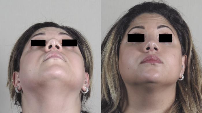Rhinoplasty Case 1223 Before & After View #3 | Paramus, New Jersey | Parker Center for Plastic Surgery
