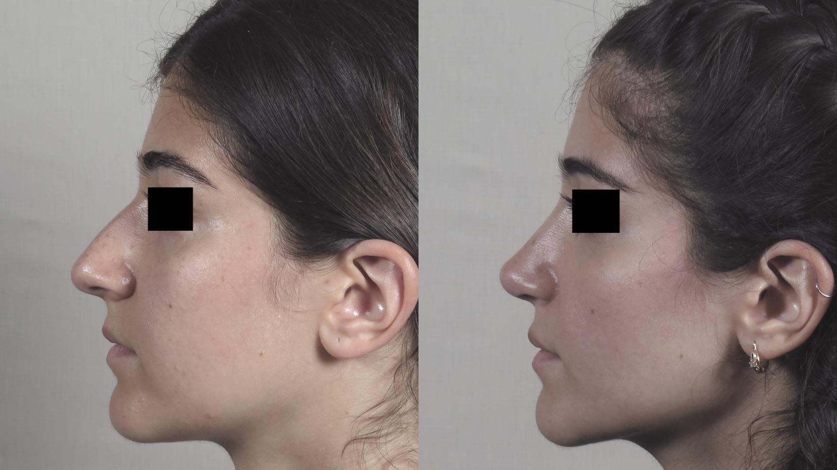 Rhinoplasty Case 1224 Before & After View #1  | Paramus, New Jersey | Parker Center for Plastic Surgery