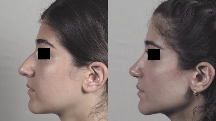 Rhinoplasty Case 1224 Before & After View #1  | Paramus, New Jersey | Parker Center for Plastic Surgery