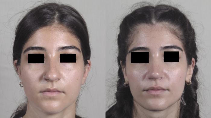 Rhinoplasty Case 1224 Before & After View #2 | Paramus, New Jersey | Parker Center for Plastic Surgery