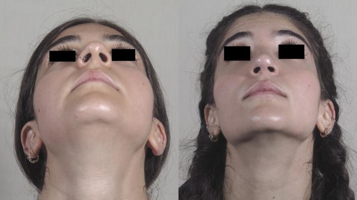 Rhinoplasty Case 1224 Before & After View #3 | Paramus, New Jersey | Parker Center for Plastic Surgery