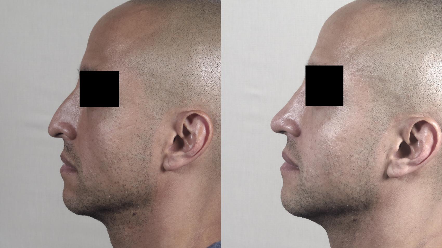 Rhinoplasty Case 1227 Before & After View #1  | Paramus, New Jersey | Parker Center for Plastic Surgery