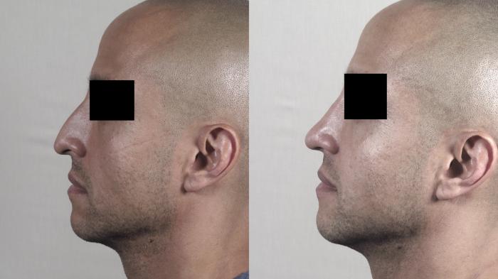 Rhinoplasty Case 1227 Before & After View #1  | Paramus, New Jersey | Parker Center for Plastic Surgery