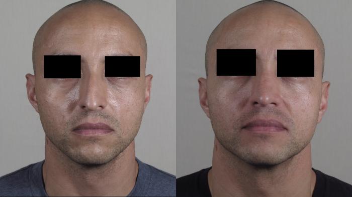 Rhinoplasty Case 1227 Before & After View #2 | Paramus, New Jersey | Parker Center for Plastic Surgery