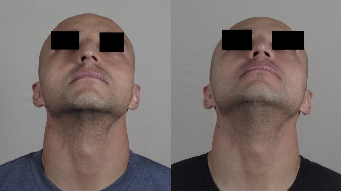 Rhinoplasty Case 1227 Before & After View #3 | Paramus, New Jersey | Parker Center for Plastic Surgery