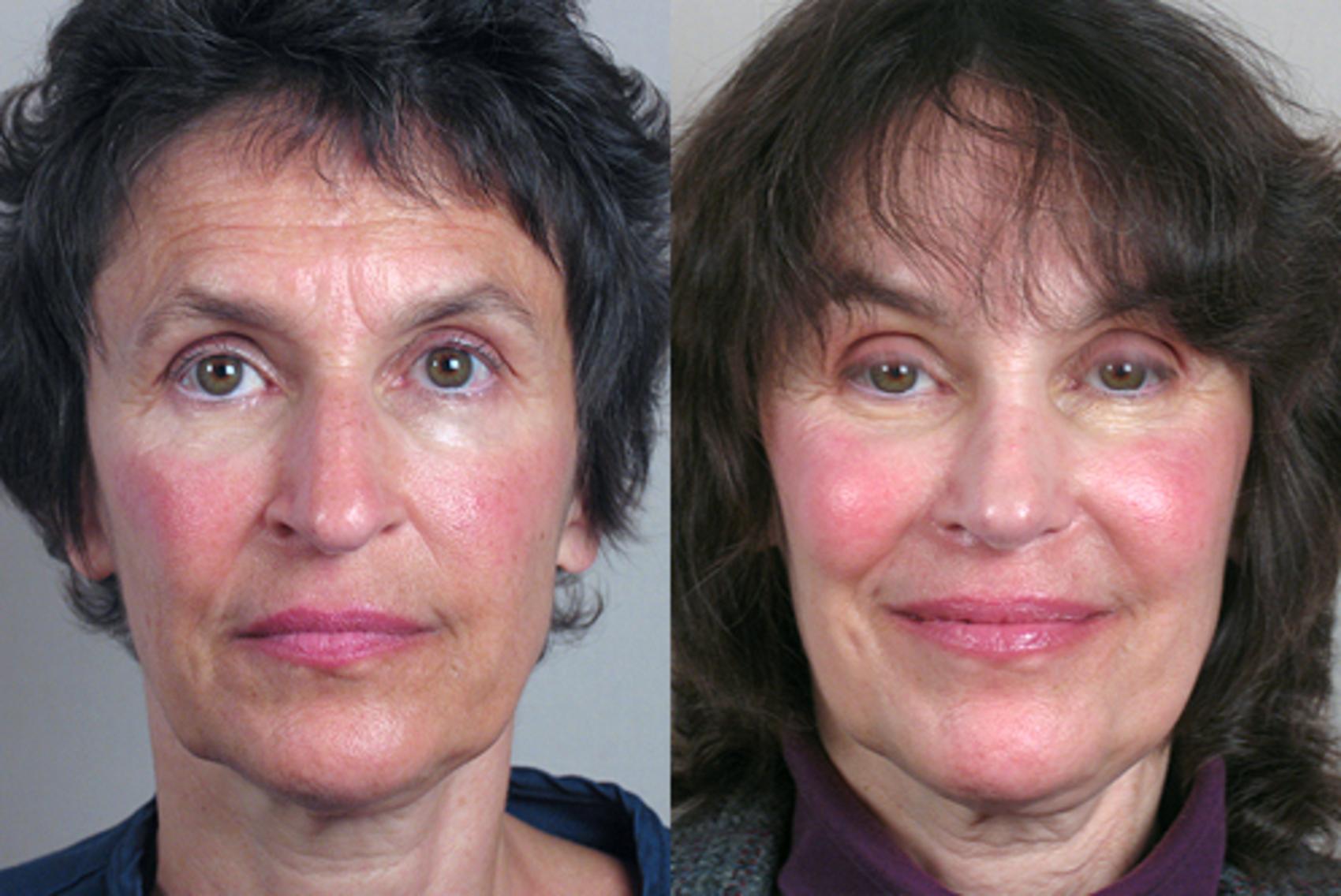 Rhinoplasty Case 123 Before & After View #1 | Paramus, New Jersey | Parker Center for Plastic Surgery