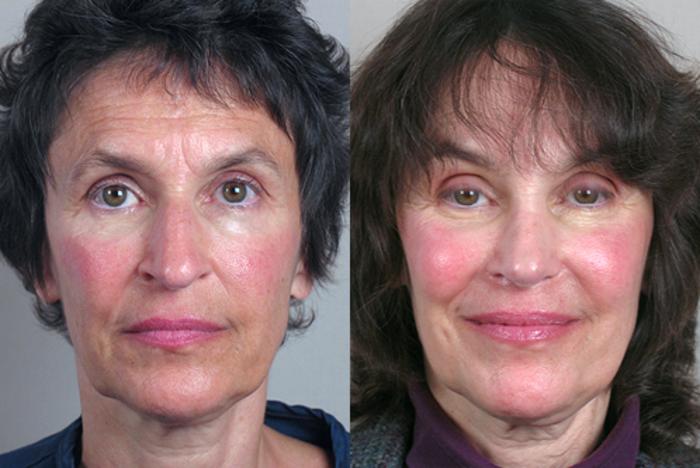 Rhinoplasty Case 123 Before & After View #1 | Paramus, New Jersey | Parker Center for Plastic Surgery