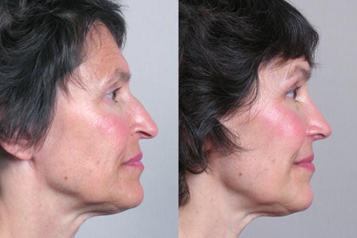Rhinoplasty Case 123 Before & After View #2 | Paramus, New Jersey | Parker Center for Plastic Surgery