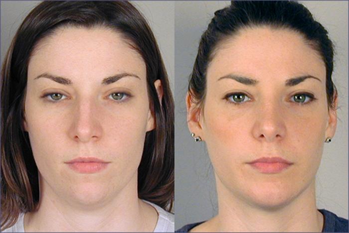 Rhinoplasty Case 124 Before & After View #1 | Paramus, New Jersey | Parker Center for Plastic Surgery