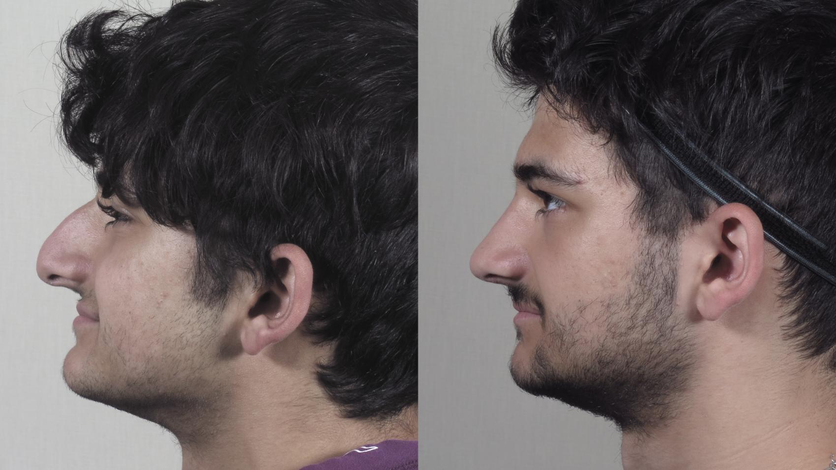 Rhinoplasty Case 1253 Before & After Left Side | Paramus, New Jersey | Parker Center for Plastic Surgery
