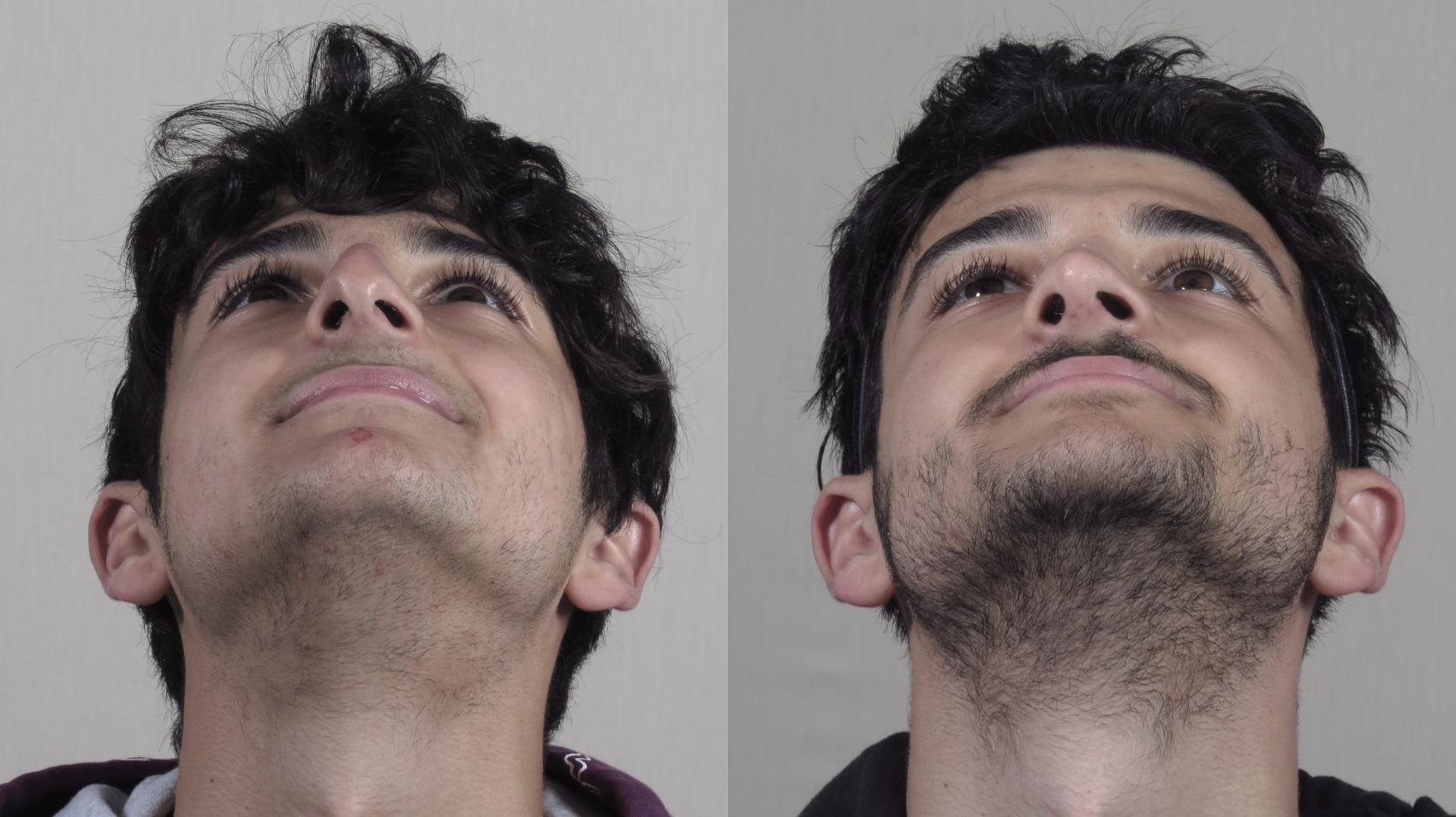 Rhinoplasty Case 1253 Before & After Worns View  | Paramus, New Jersey | Parker Center for Plastic Surgery