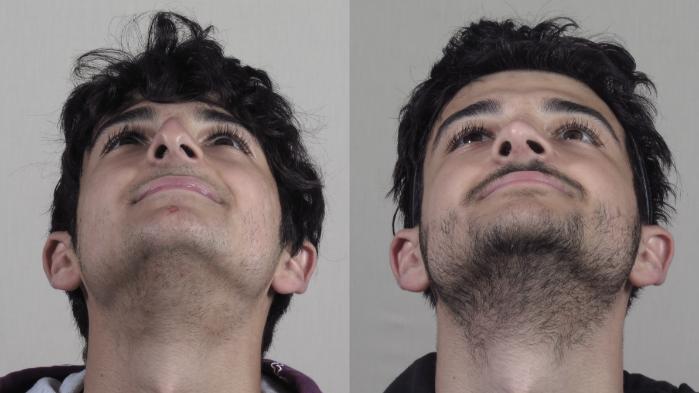 Rhinoplasty Case 1253 Before & After Worns View  | Paramus, New Jersey | Parker Center for Plastic Surgery