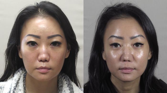 Rhinoplasty Case 1254 Before & After Front | Paramus, New Jersey | Parker Center for Plastic Surgery