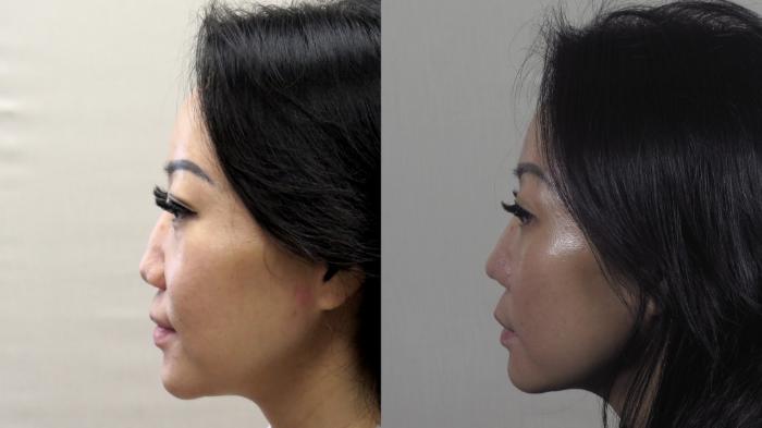 Rhinoplasty Case 1254 Before & After Left Side | Paramus, New Jersey | Parker Center for Plastic Surgery