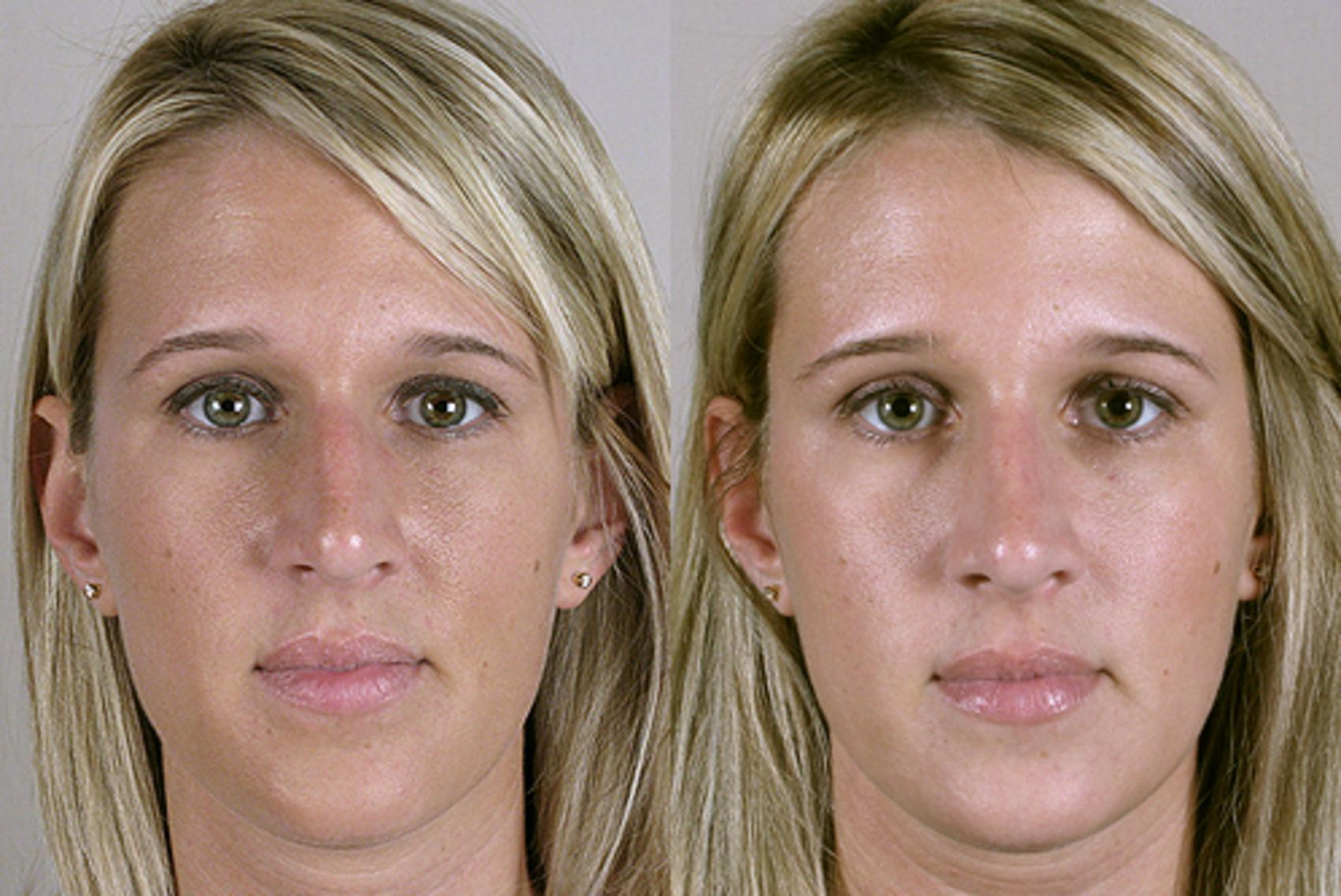 Rhinoplasty Case 126 Before & After View #1 | Paramus, New Jersey | Parker Center for Plastic Surgery