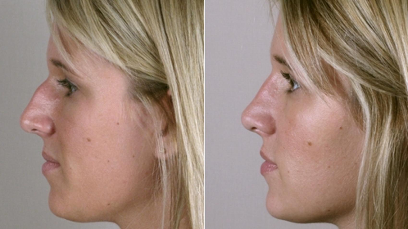 Rhinoplasty Case 126 Before & After View #2 | Paramus, New Jersey | Parker Center for Plastic Surgery