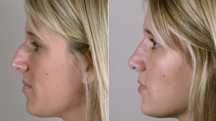 Rhinoplasty Case 126 Before & After View #2 | Paramus, New Jersey | Parker Center for Plastic Surgery