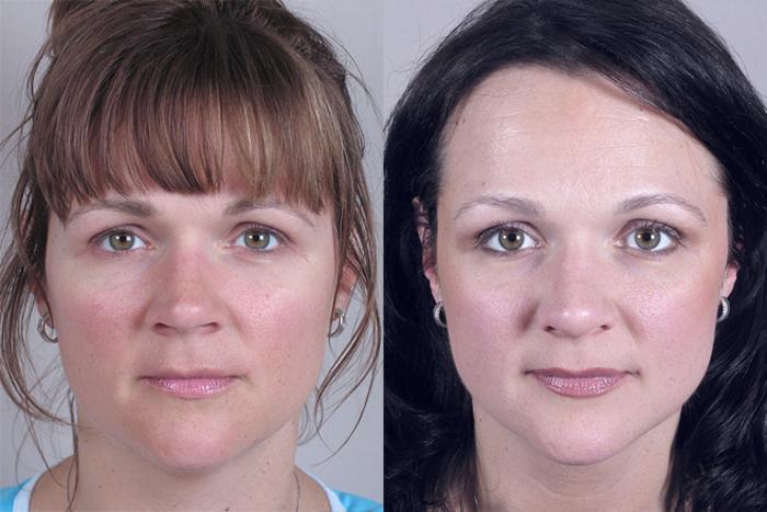 Rhinoplasty Case 127 Before & After View #1 | Paramus, New Jersey | Parker Center for Plastic Surgery