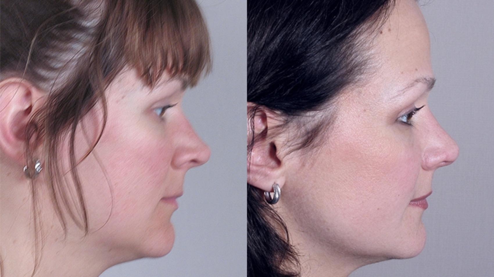 Rhinoplasty Case 127 Before & After View #2 | Paramus, New Jersey | Parker Center for Plastic Surgery