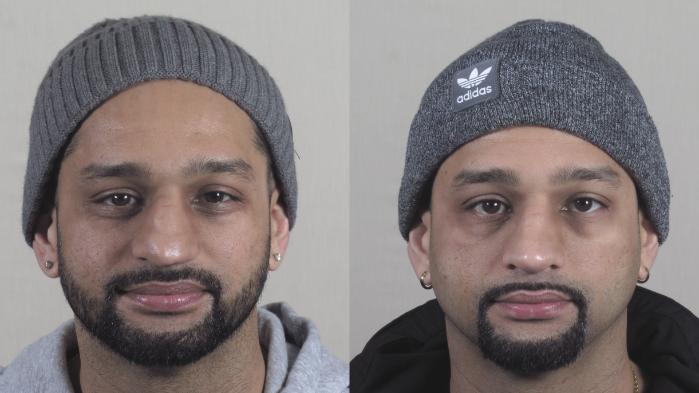 Rhinoplasty Case 1270 Before & After Front | Paramus, New Jersey | Parker Center for Plastic Surgery